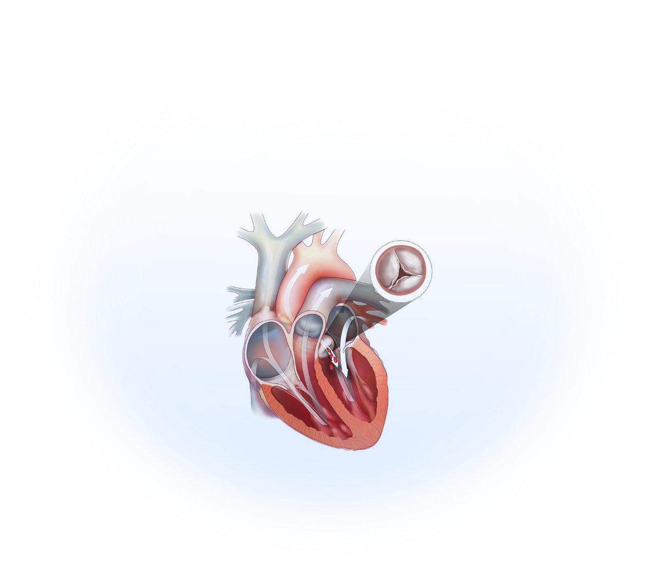 Aortic regurgitation