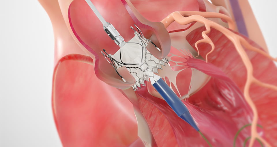 TAVR