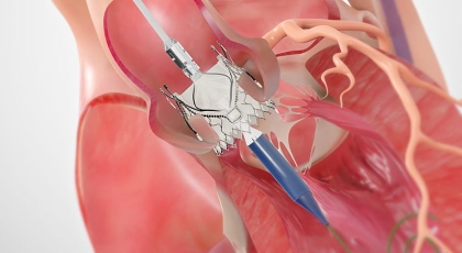 Trilogy Procedural Animation